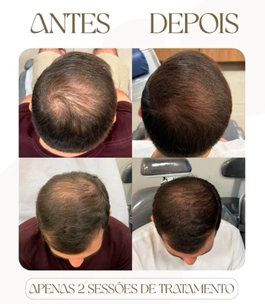 Pós-Transplante Capilar